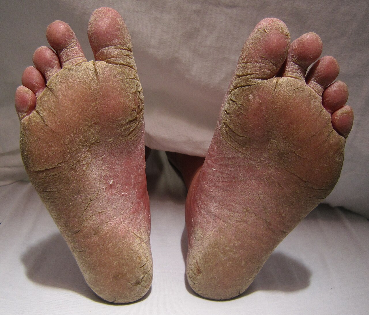Piel del pie con tinea