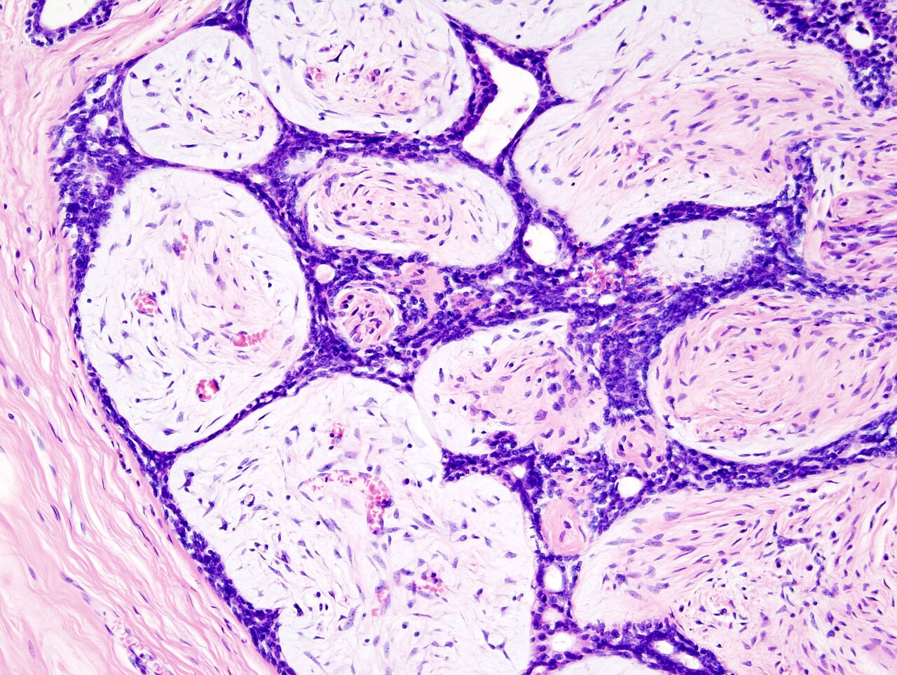 Imagen mamaria de fibroadenoma