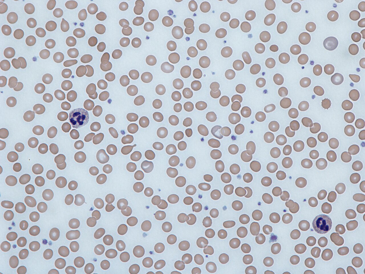 Frotis de sangre con hipocromía (anemia)
