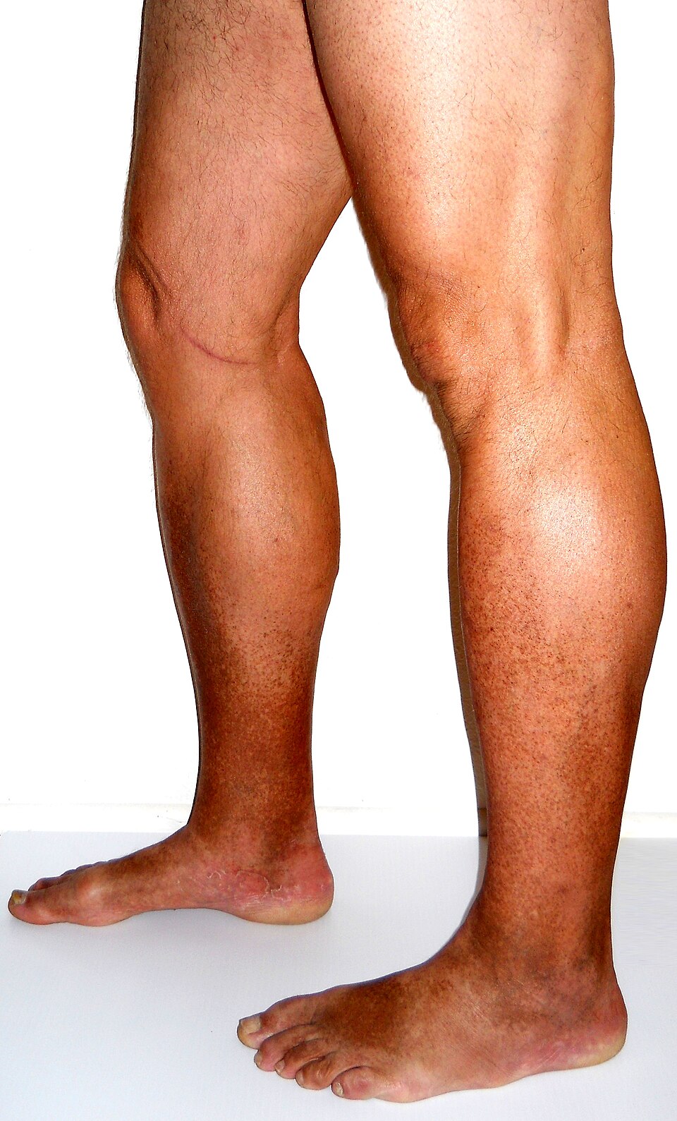 Piernas con edema venoso